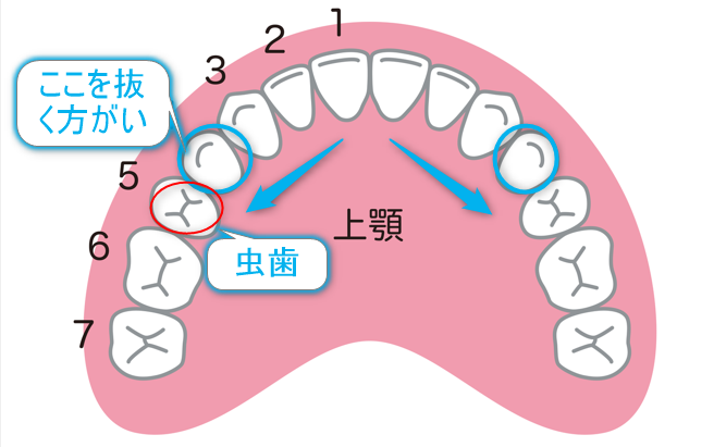 上顎の歯列